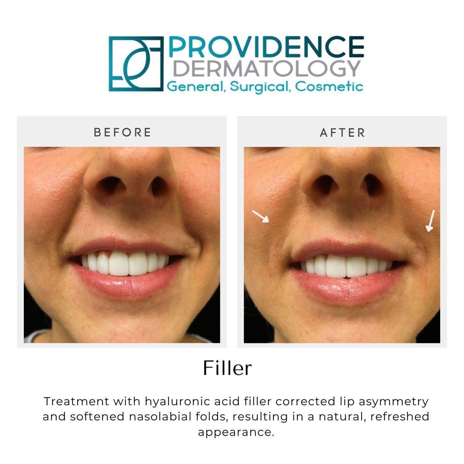 Before-and-after lip filler results showing improved lip symmetry and reduced nasolabial folds, with arrows highlighting changes