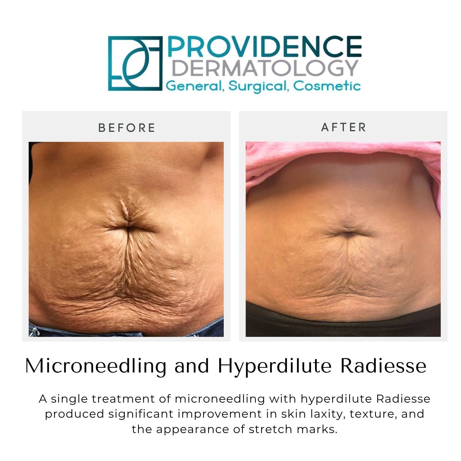 Before-and-after photos of hyperdilute Radiesse treatment on an abdomen with stretch marks and loose skin
