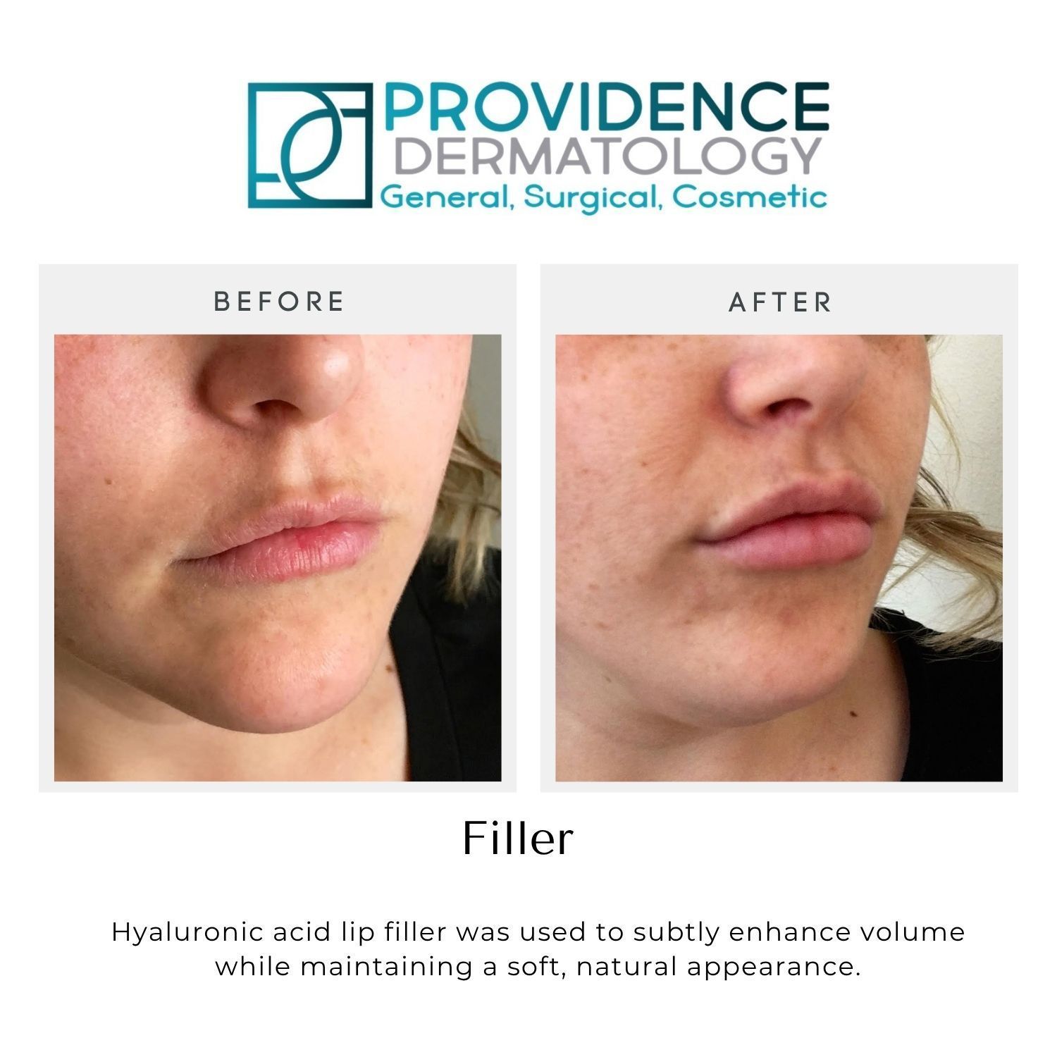 Before-and-after close-up of lips showing filler results, with Providence Dermatology branding.