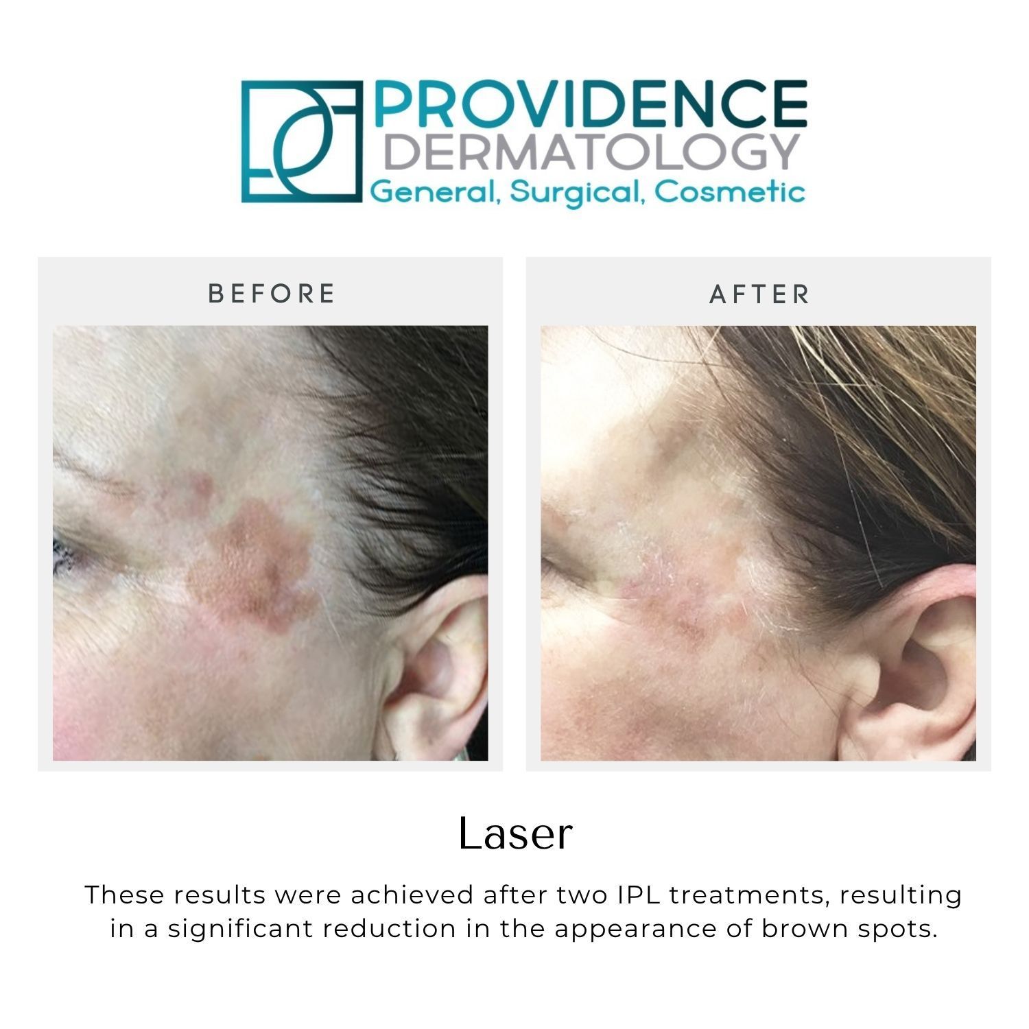 Before-and-after close-ups of a temple showing reduced brown spots after laser treatment.