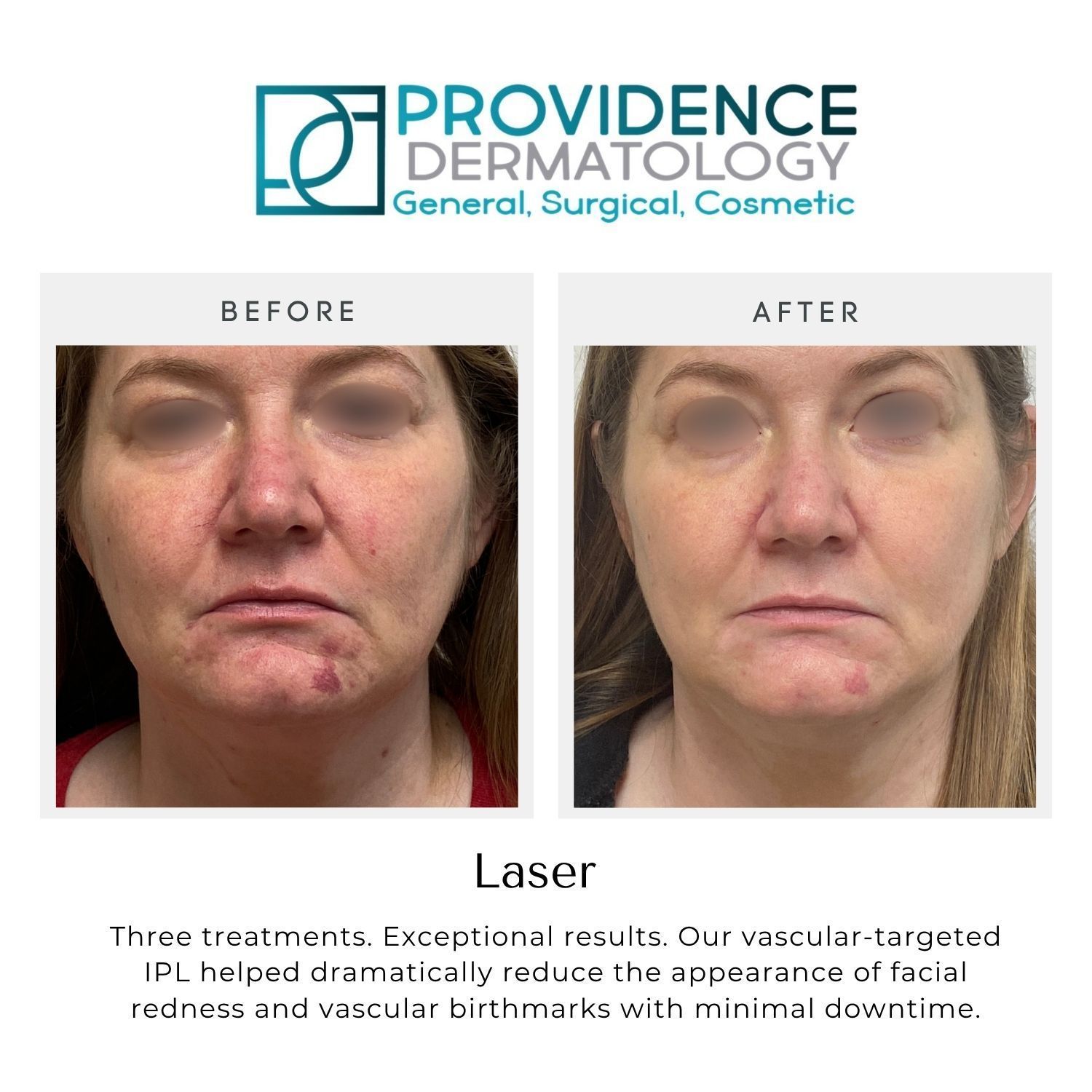 Providence Dermatology before-and-after facial laser treatment results showing reduced redness and wrinkles