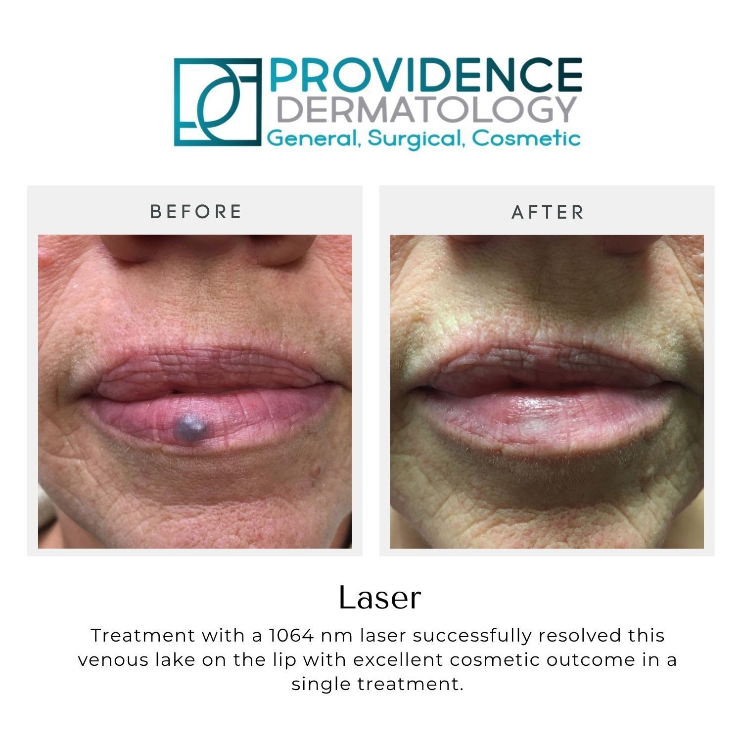 Before-and-after close-up of lip vein treatment at Providence Dermatology, showing reduced purple bump after laser therapy