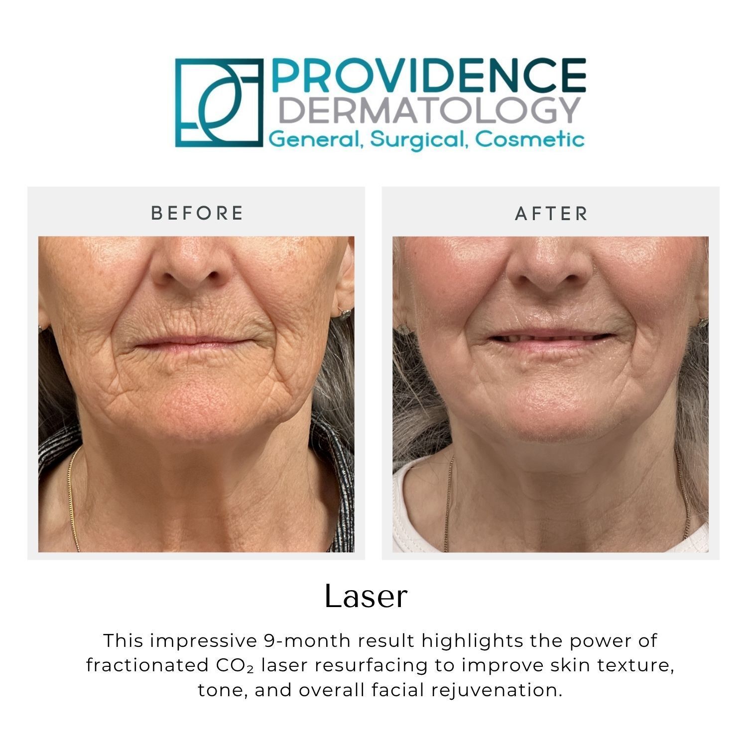 Providence Dermatology laser before-and-after facial skin treatment comparison
