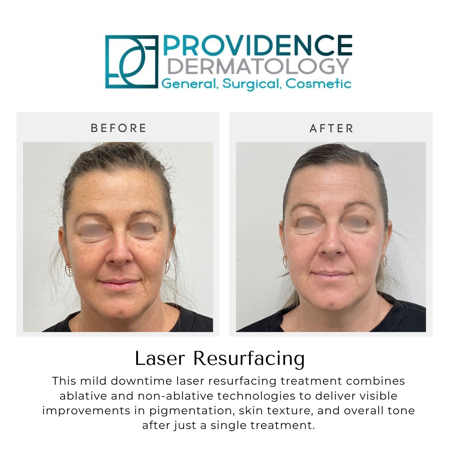 Before-and-after facial laser resurfacing results from Providence Dermatology