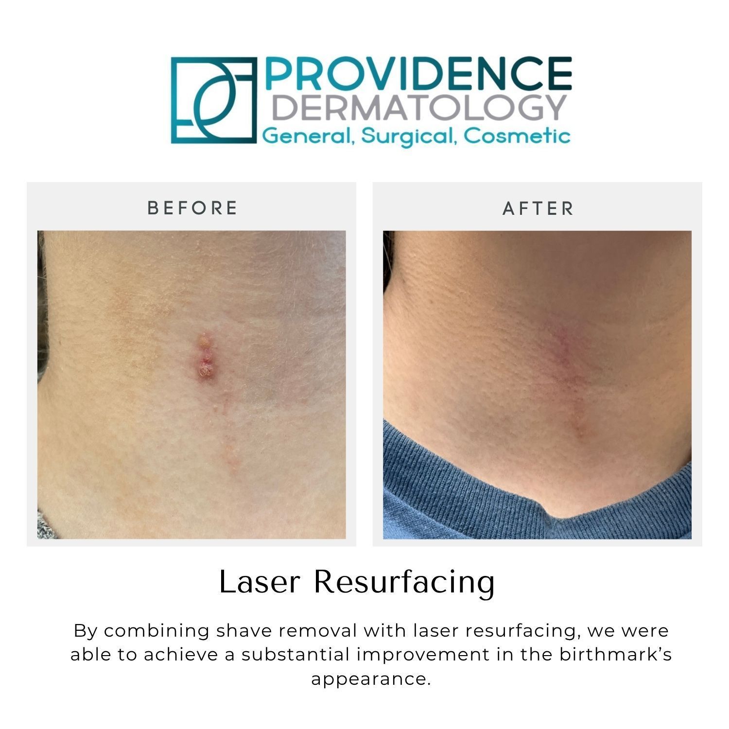 Providence Dermatology before-and-after laser resurfacing results on a birthmark