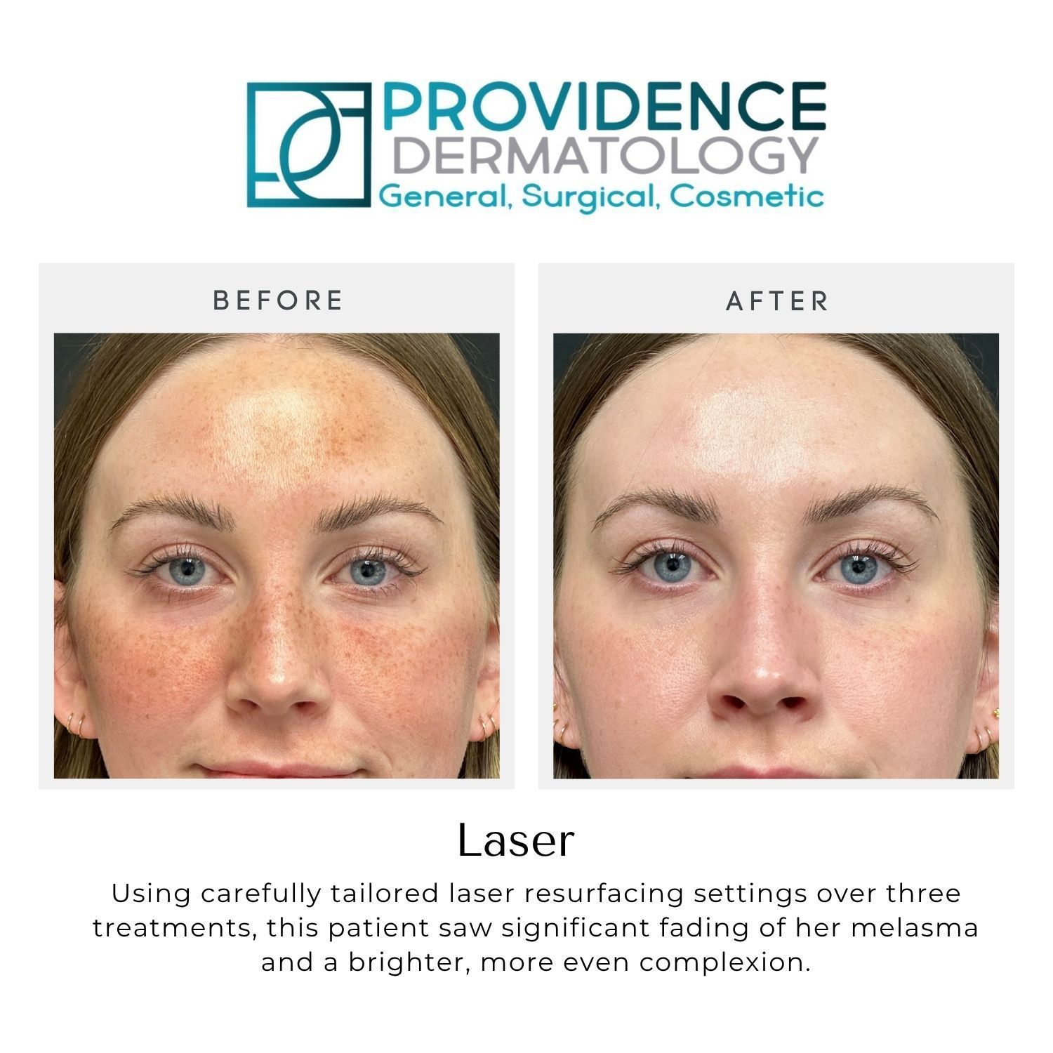 Before-and-after facial laser treatment results at Providence Dermatology, showing reduced redness and brown spots.
