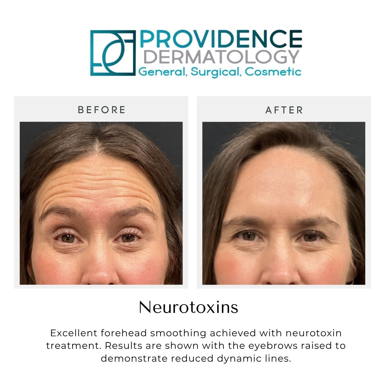 Before-and-after forehead photos showing smoother skin and fewer wrinkles after neurotoxin treatment.