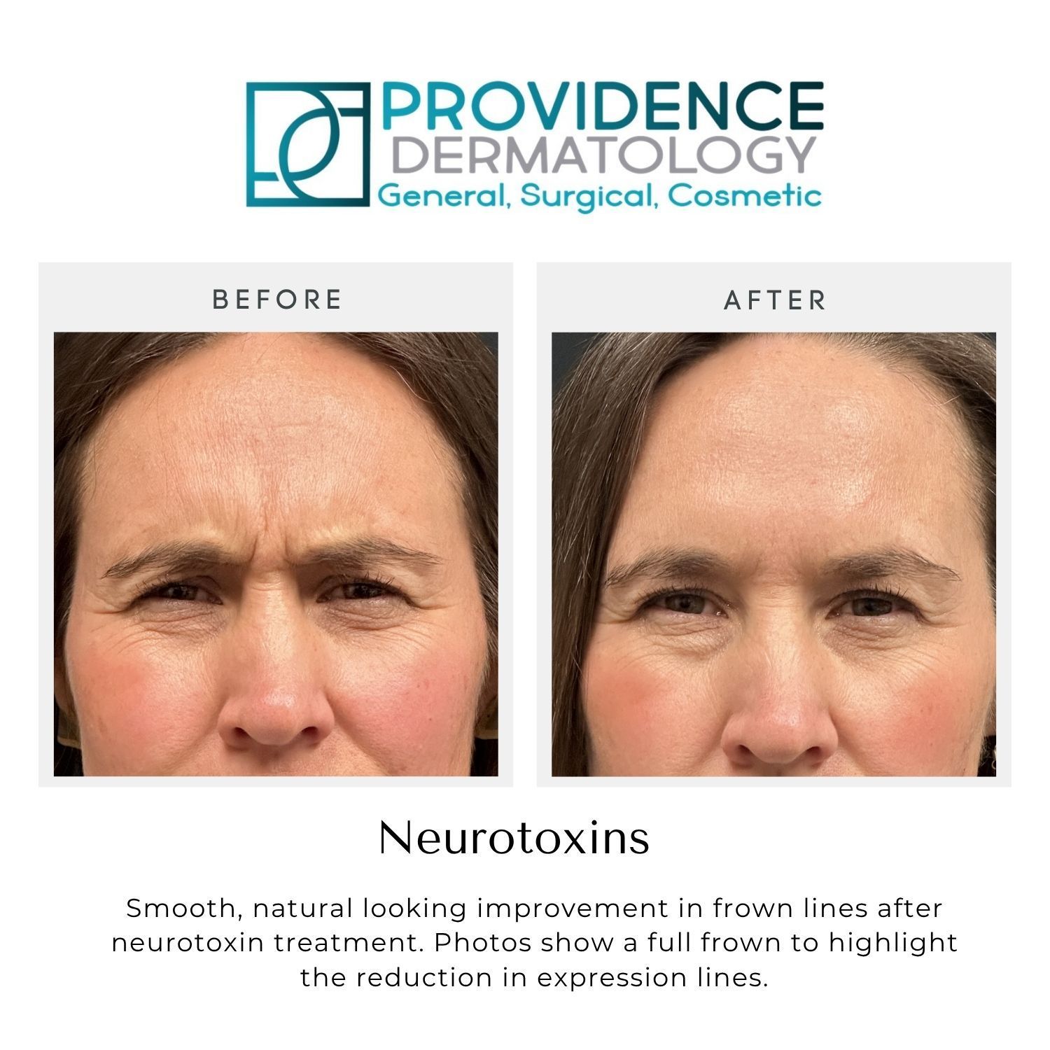 Before-and-after forehead photos showing reduced frown lines after neurotoxin treatment