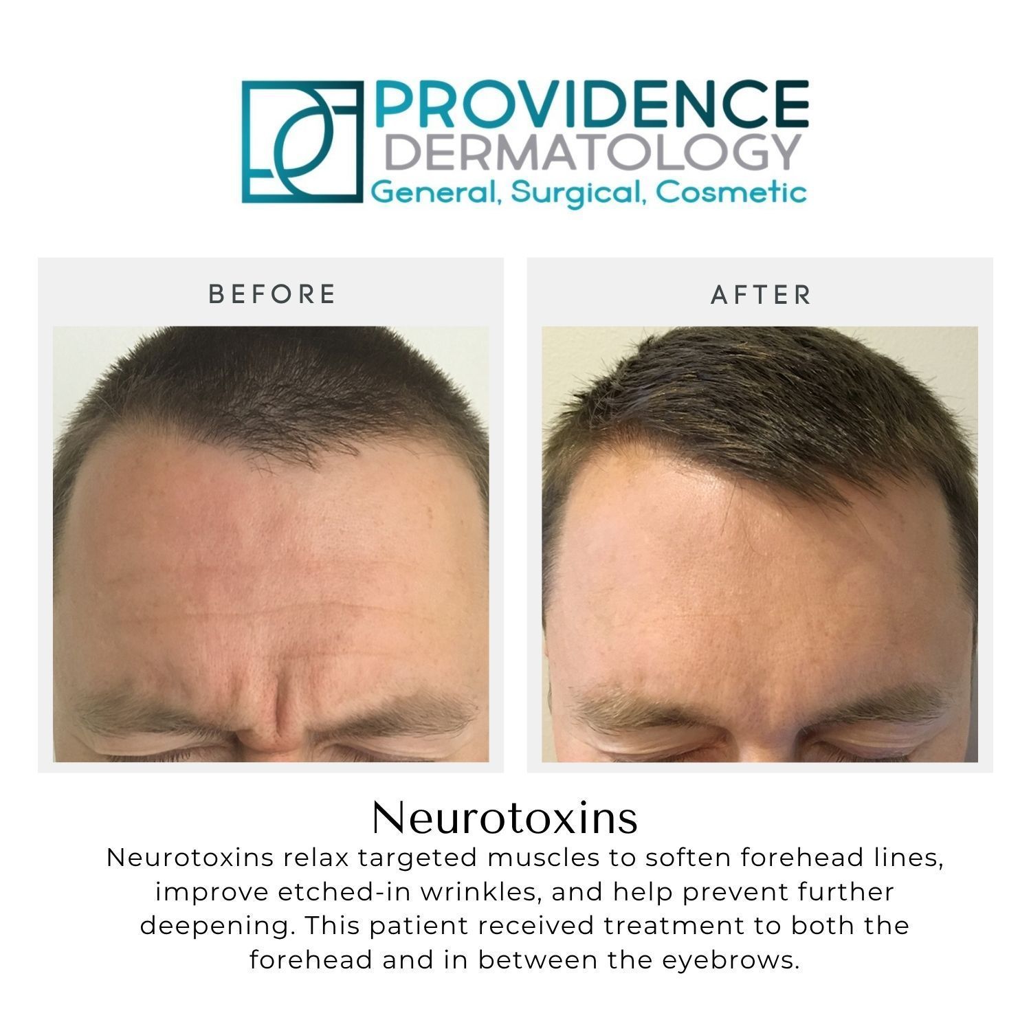 Before-and-after forehead photos promoting Botox treatment at Providence Dermatology