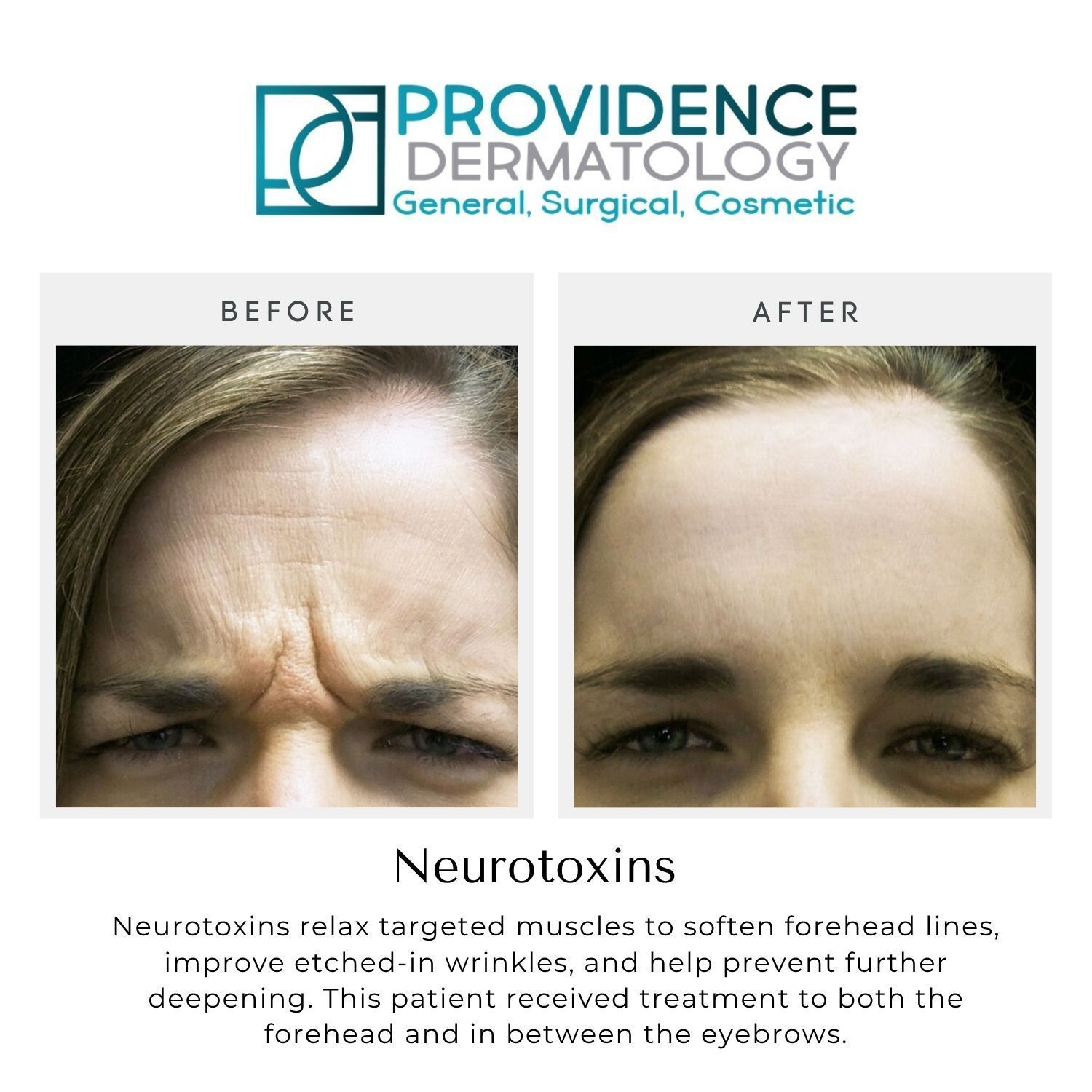 Providence Dermatology before-and-after forehead treatment photos showing reduced wrinkles
