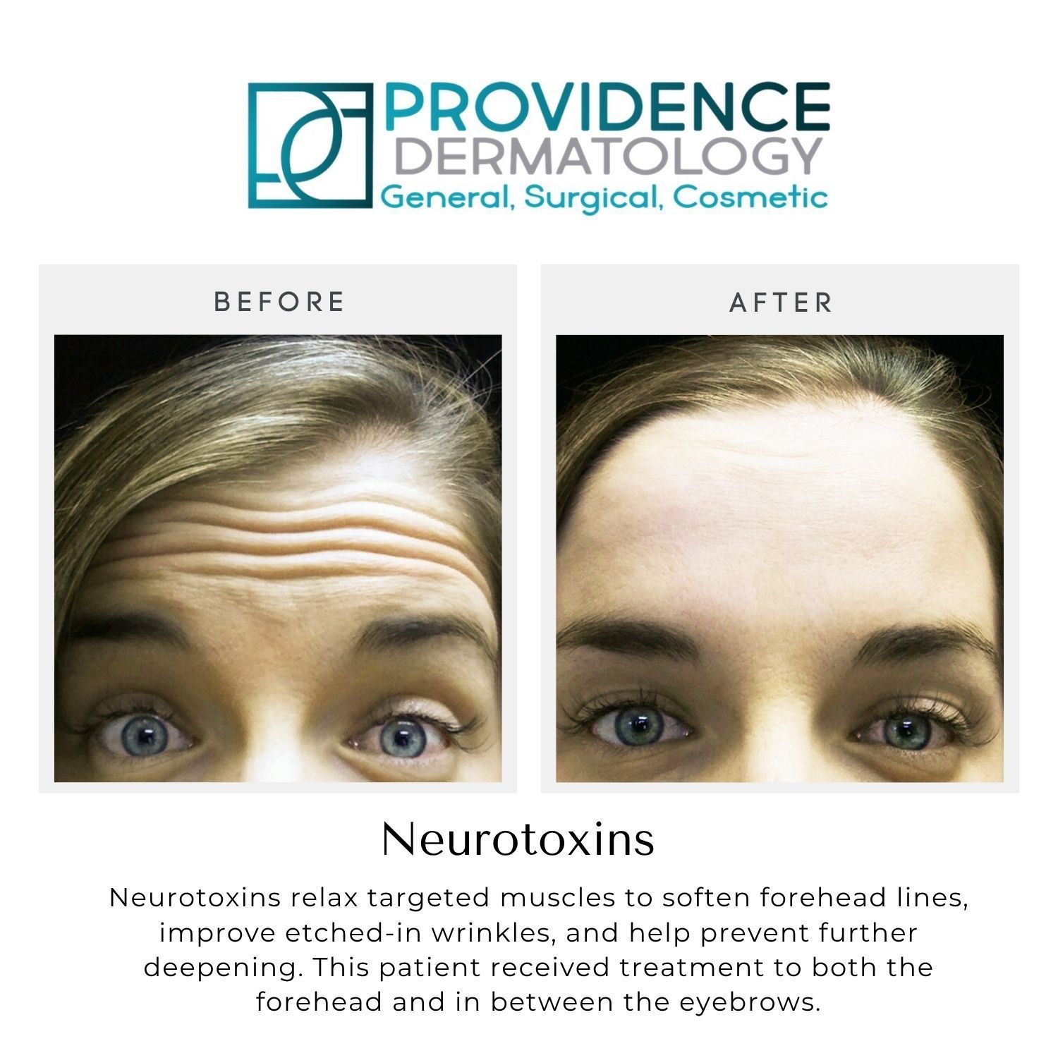 Before-and-after forehead treatment photos from Providence Dermatology, showing fewer wrinkles after treatment.