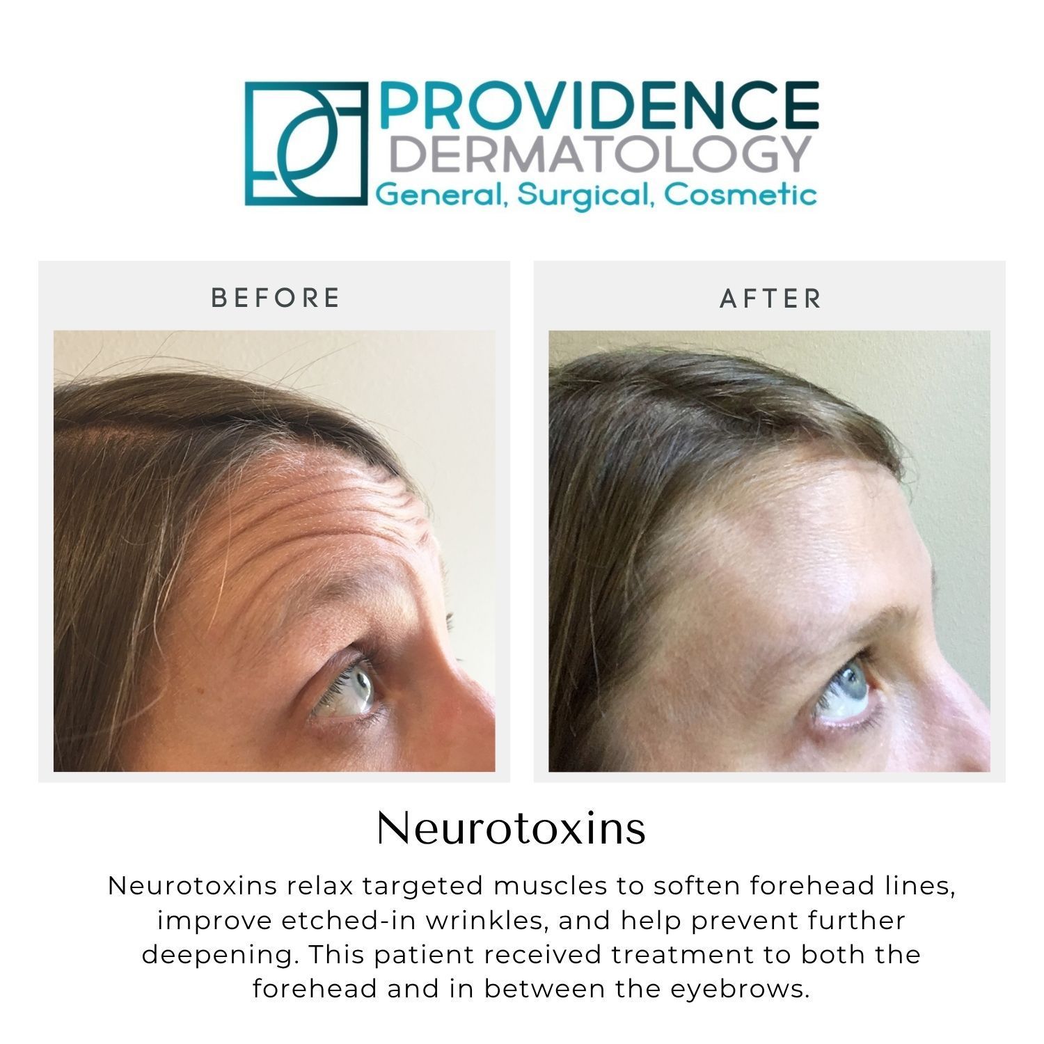 Before-and-after close-up of forehead wrinkles, showing smoother skin after neurotoxin treatment.