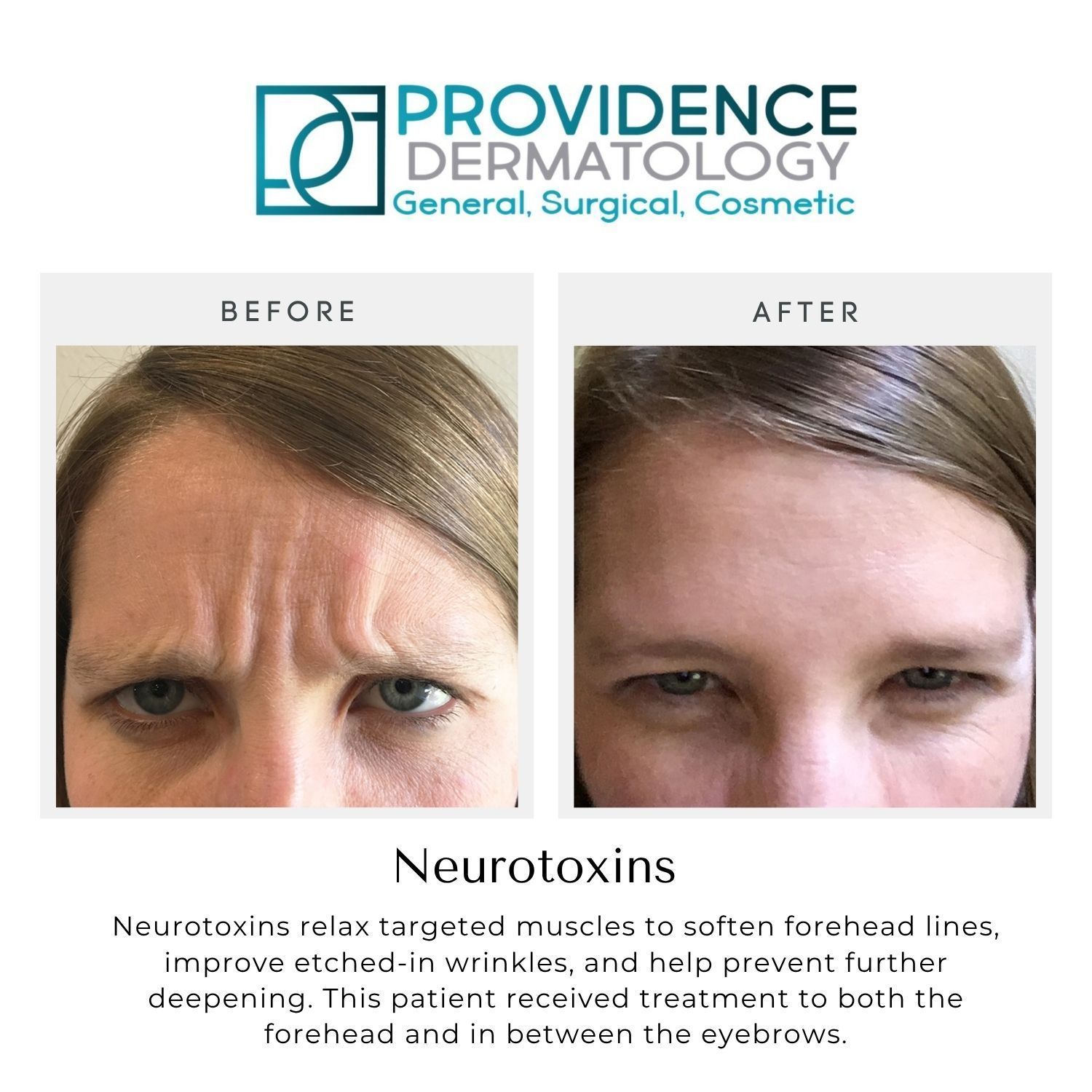 Providence Dermatology before-and-after forehead wrinkle treatment photos