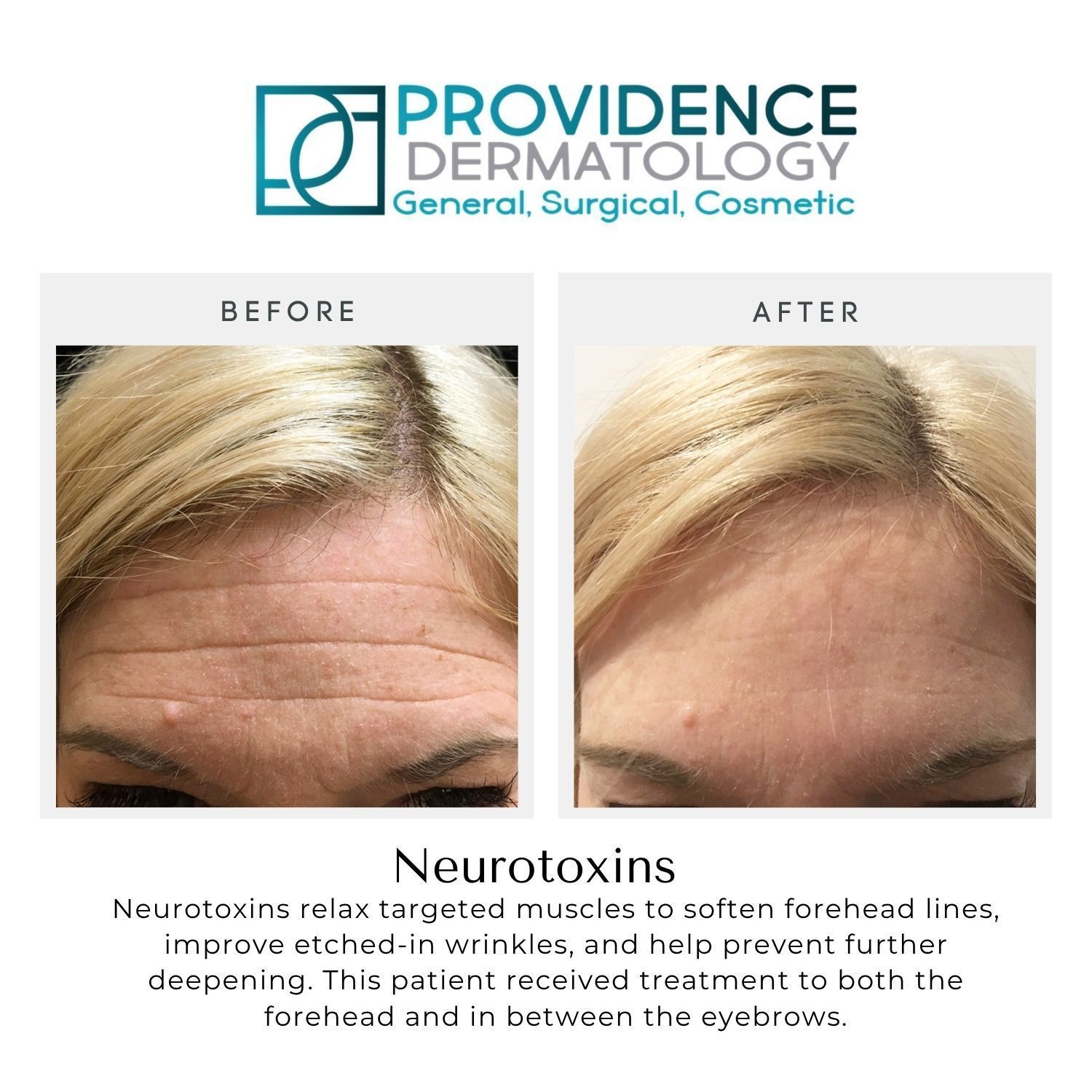 Before-and-after forehead photos showing reduced wrinkles after neuromodulator treatment at Providence Dermatology