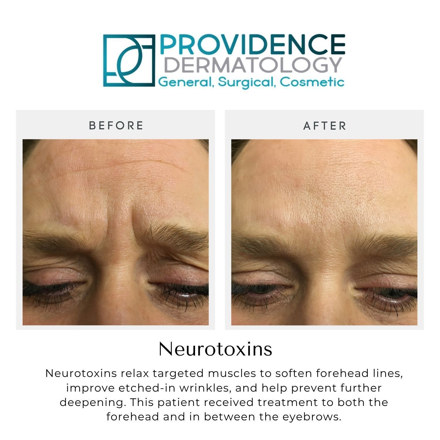 Before-and-after close-up of forehead wrinkles, showing smoother skin after neurotoxin treatment.