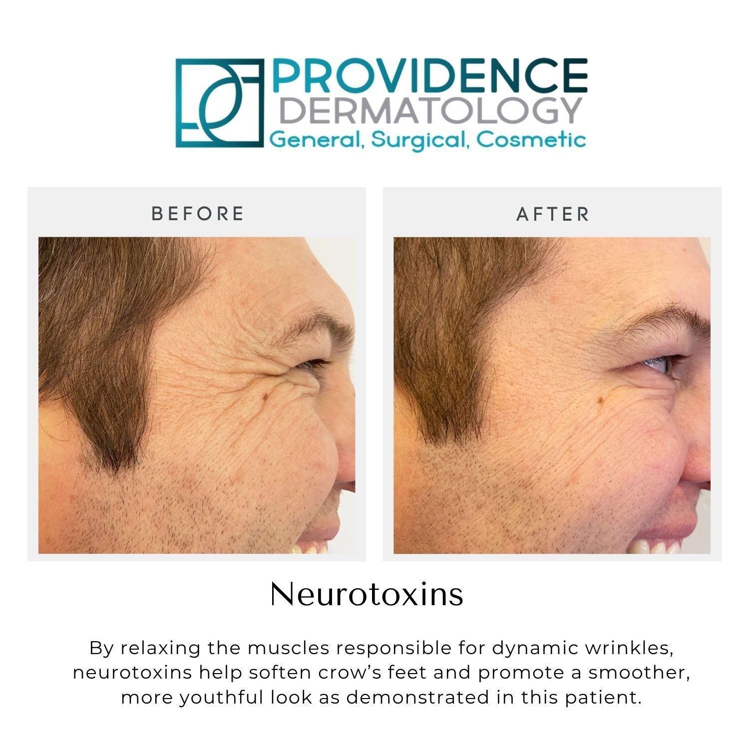 Before-and-after profile of a man’s face showing reduced crow’s feet, Providence Dermatology ad for neurotoxins