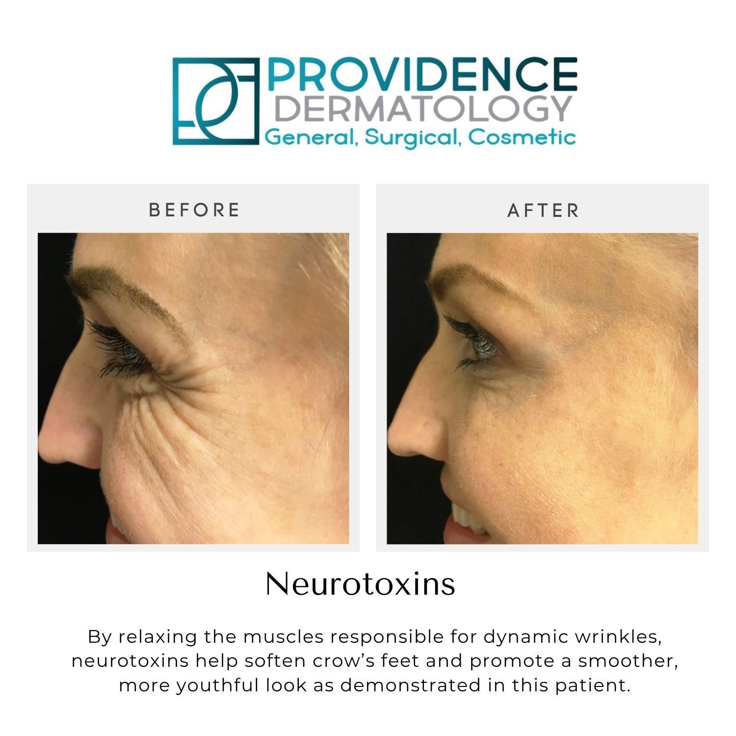 Providence Dermatology before-and-after profile photos showing reduced crow's feet after neurotoxin treatment
