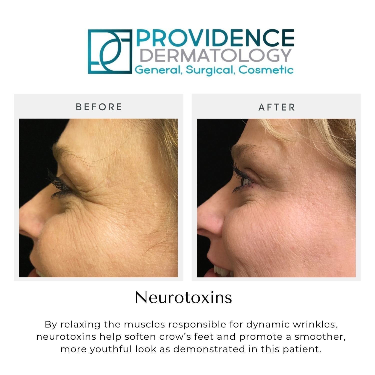 Providence Dermatology before-and-after side view showing smoother skin with neurotoxin treatment