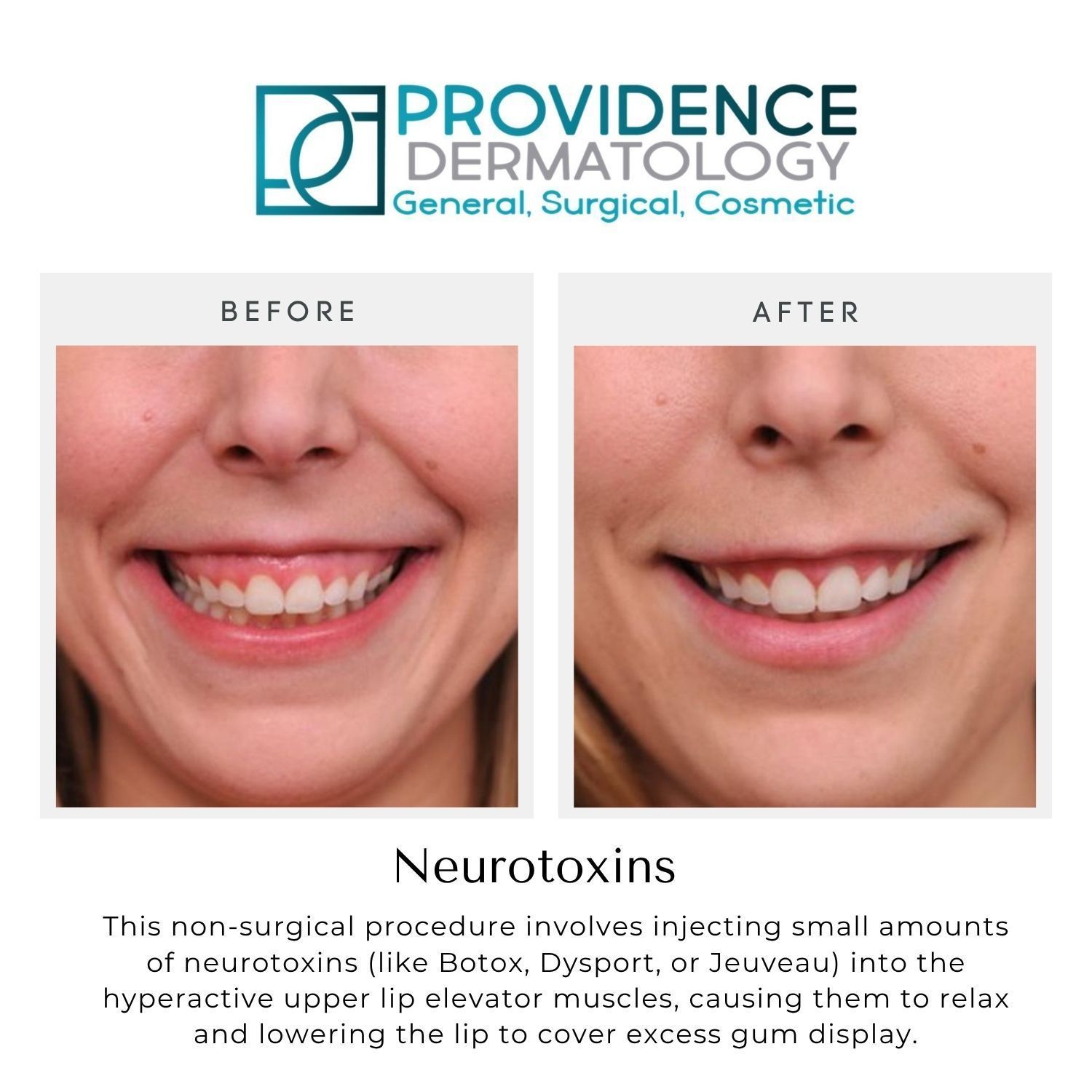 Before-and-after smile photos for neurotoxin treatment at Providence Dermatology
