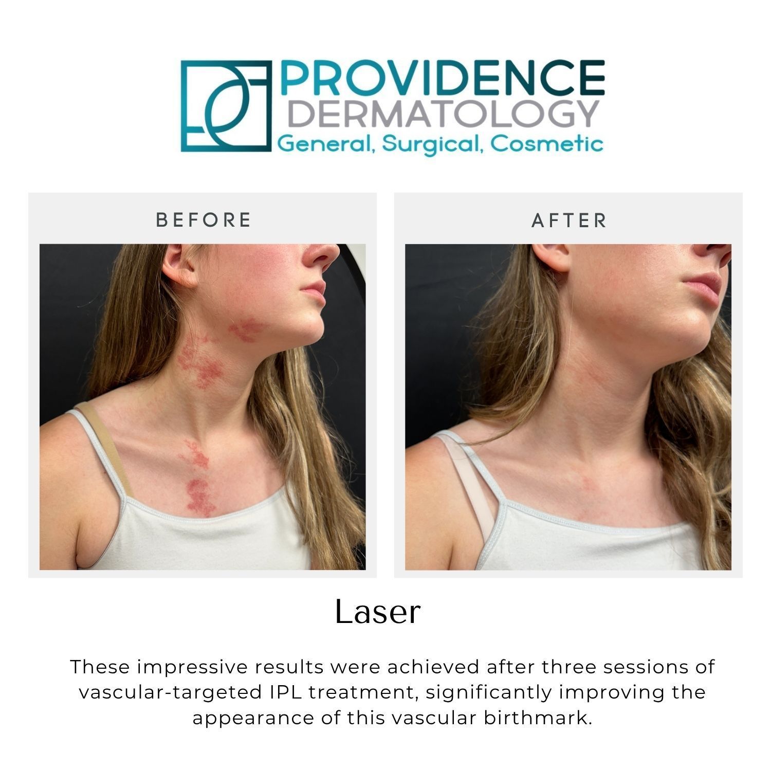 Before-and-after neck photos showing reduced red, raised scars after laser treatment at Providence Dermatology