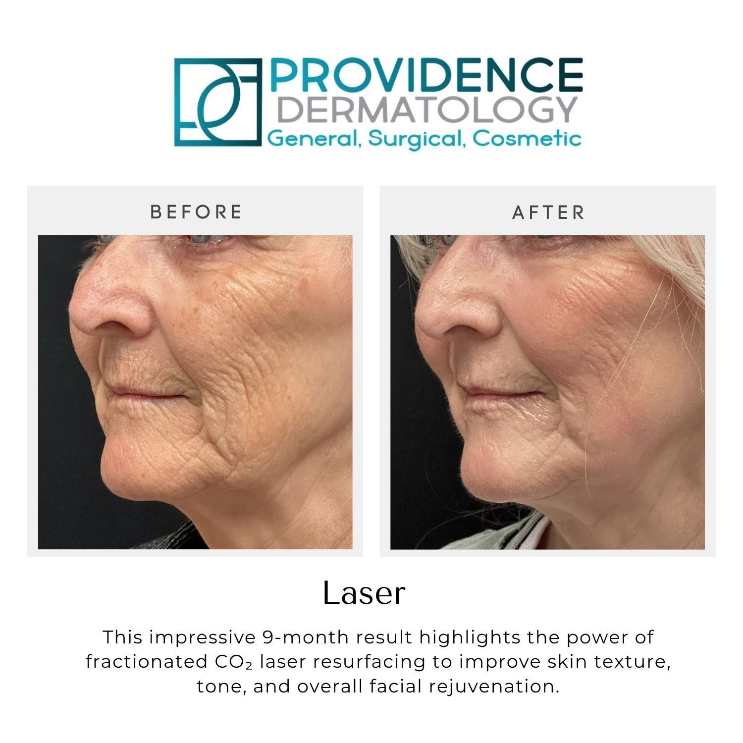 Before-and-after profile photos showing facial skin improvement after laser treatment.