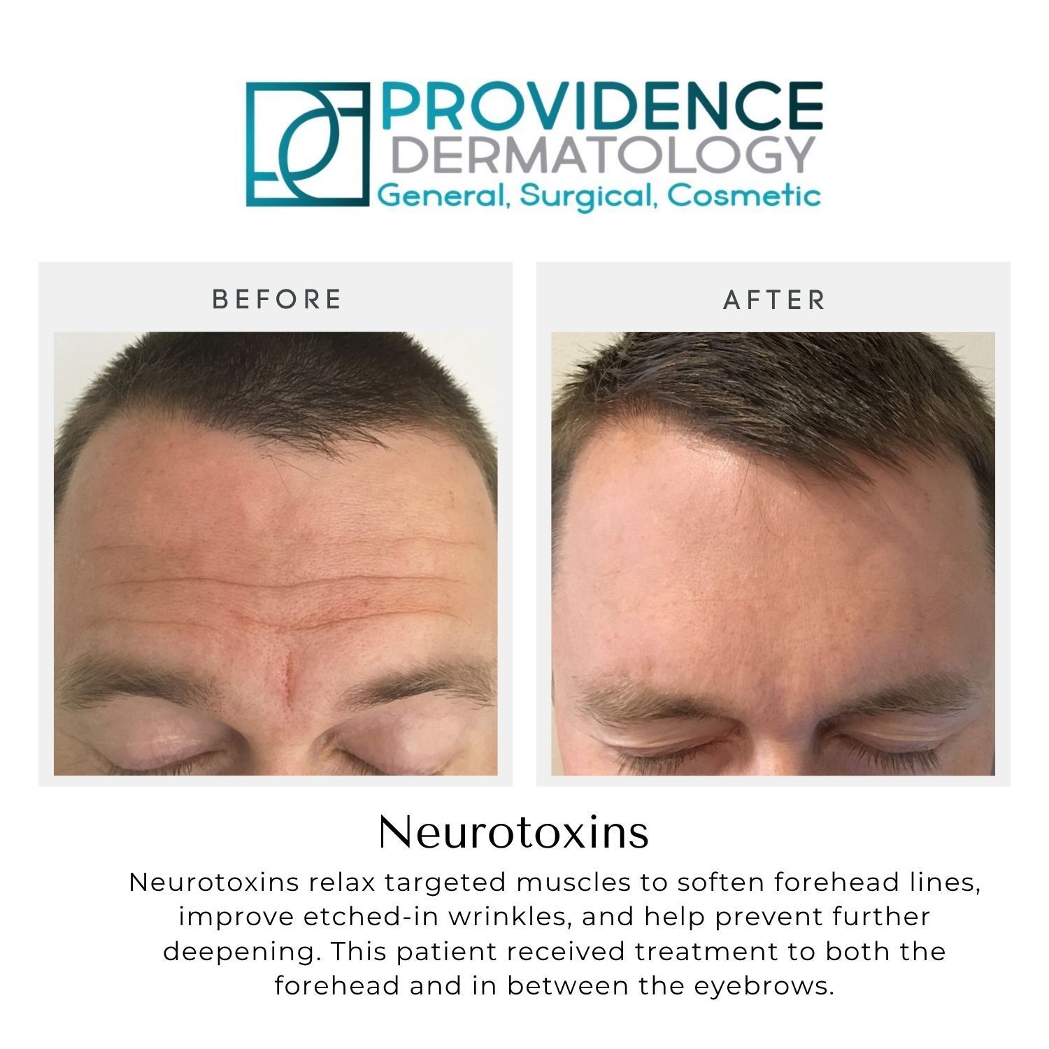 Before-and-after forehead photos showing reduced wrinkles after neurotoxin treatment by Providence Dermatology
