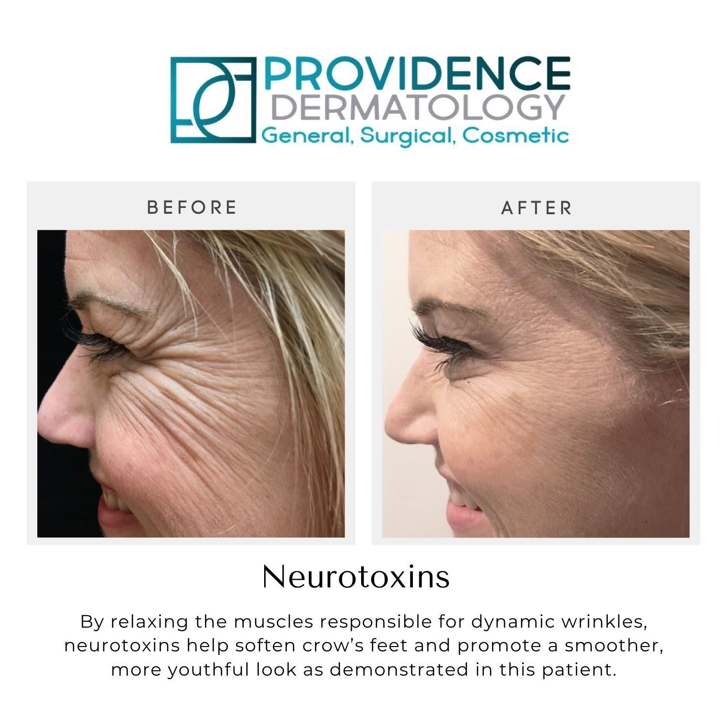 Providence Dermatology neurotoxin before-and-after side profile showing reduced crow’s feet wrinkles