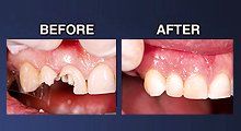 Dental surgery comparison