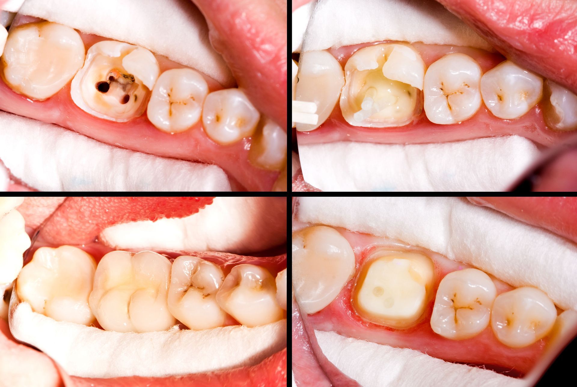 Four close-up dental views showing damaged teeth, likely needing fillings, set inside the mouth.