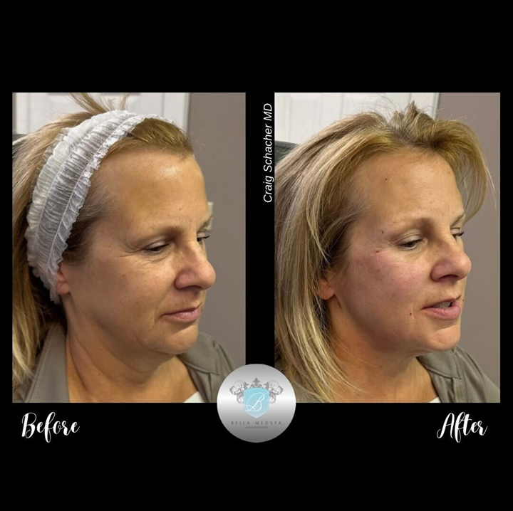 Side-by-side comparison shows a woman's face before and after a cosmetic procedure. The after face shows smoother skin.