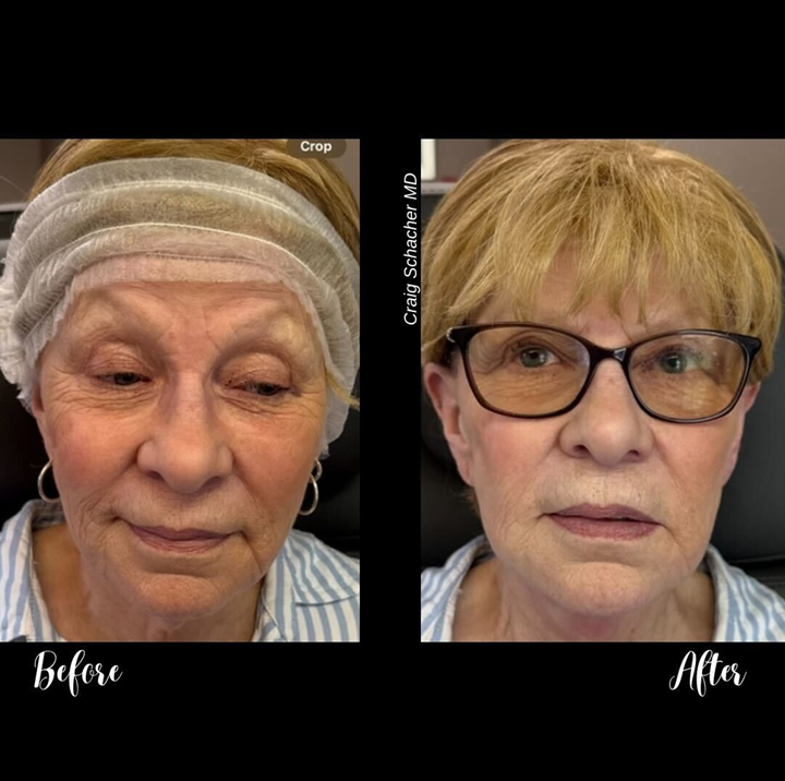 Before and after facial images. Left: woman with wrinkles. Right: woman with smoother skin, wearing glasses.
