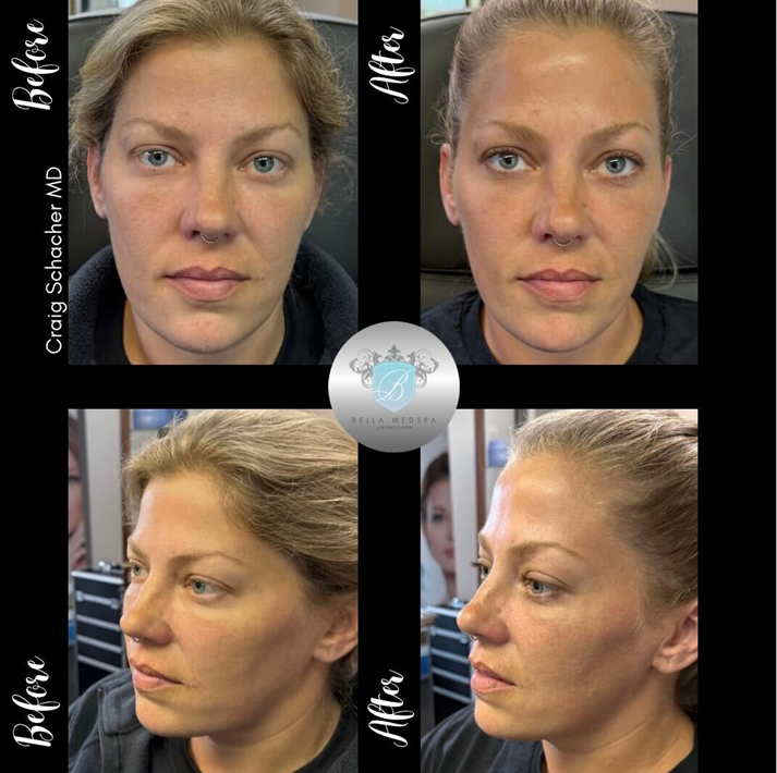 Side-by-side before and after photos of a woman's face, showing cosmetic enhancement results.