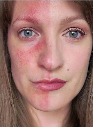 melanotan ii rosacea 2 And Treatment Rosacea Treatment Options at HMGS