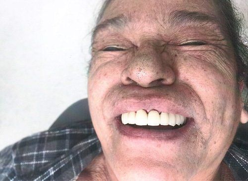 Girl Dental Crown After