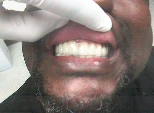 Man Dental Crown After