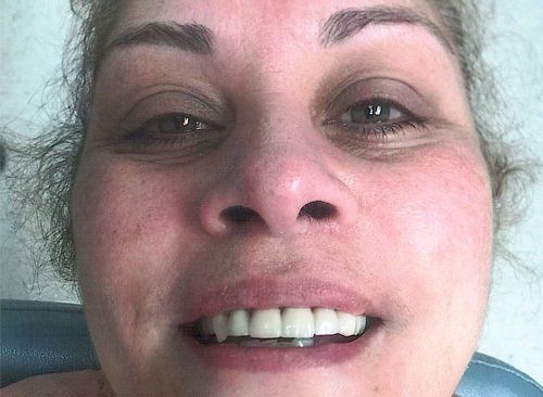 Woman's Dental Crown After