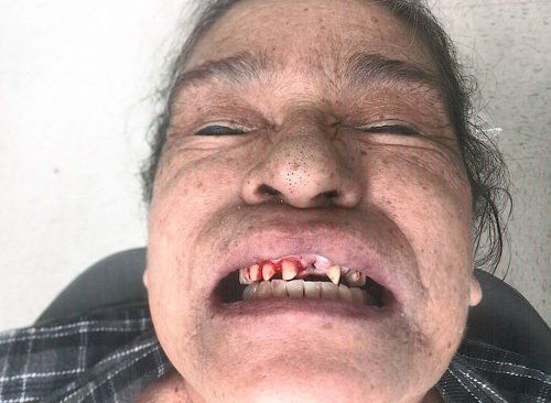 Girl Dental Crown Before