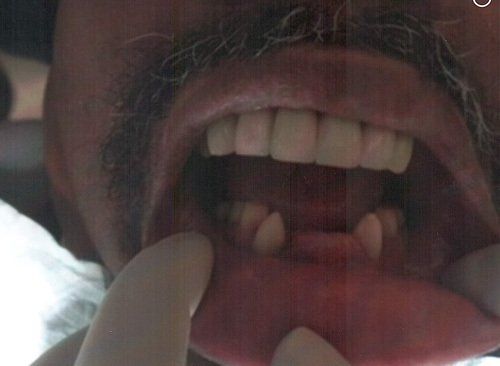 Man Dental Crown Before