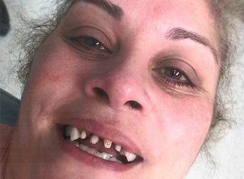 Woman's Dental Crown Before