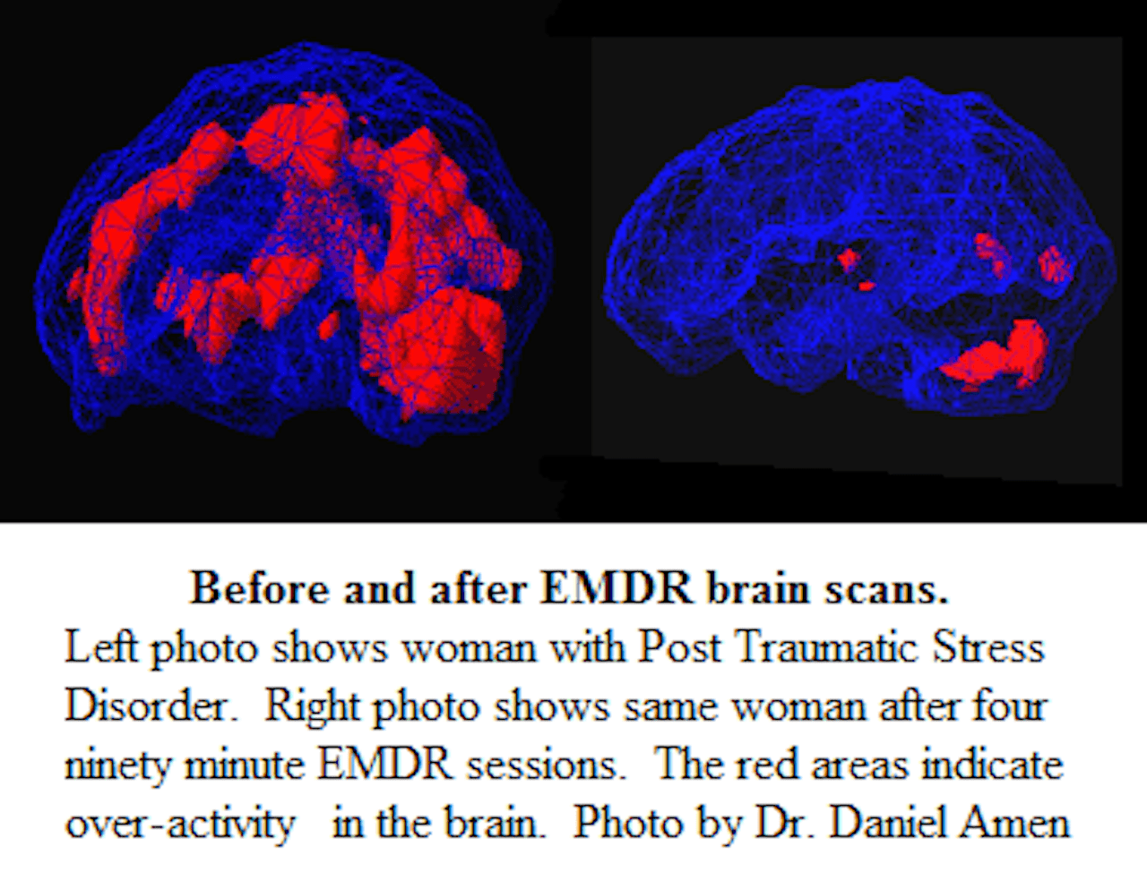 Side-by-side images depicting brain scans before and after EMDR therapy, illustrating neural changes and healing.