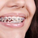 orthodontics clips