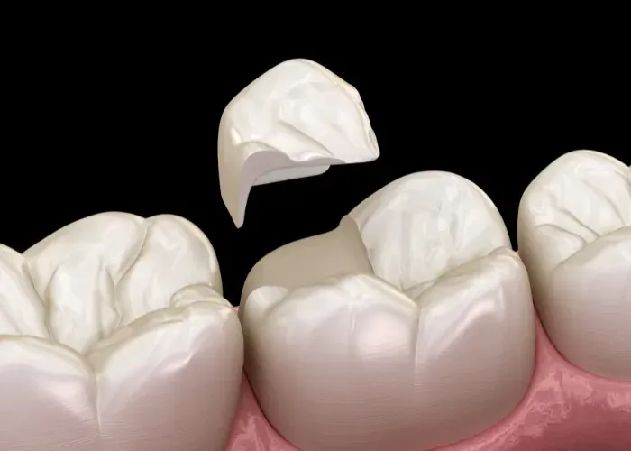 A digital illustration showing a dental inlay being positioned over the prepared biting surface of a molar tooth.