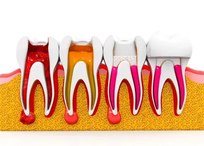 A cross-section illustration showing four stages of a root canal procedure, progressing from infection to a final crown.