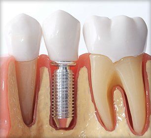 Dental implant