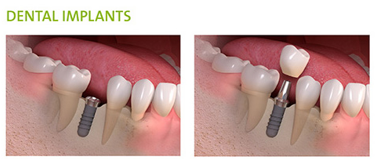 Dental Implants Smile Restorations Beaumont TX