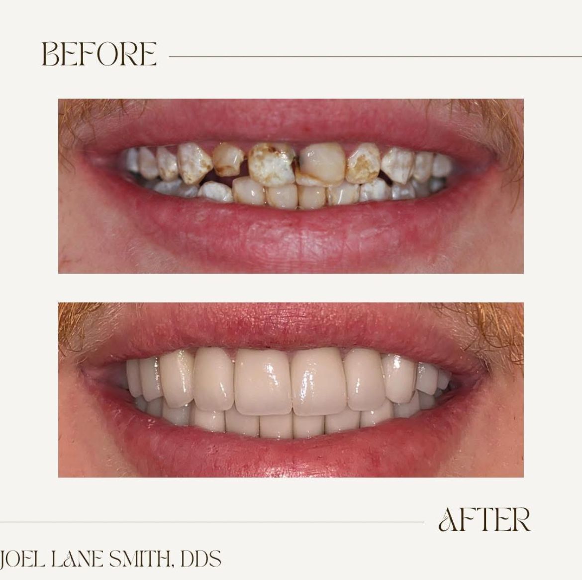 before & after images of teeth