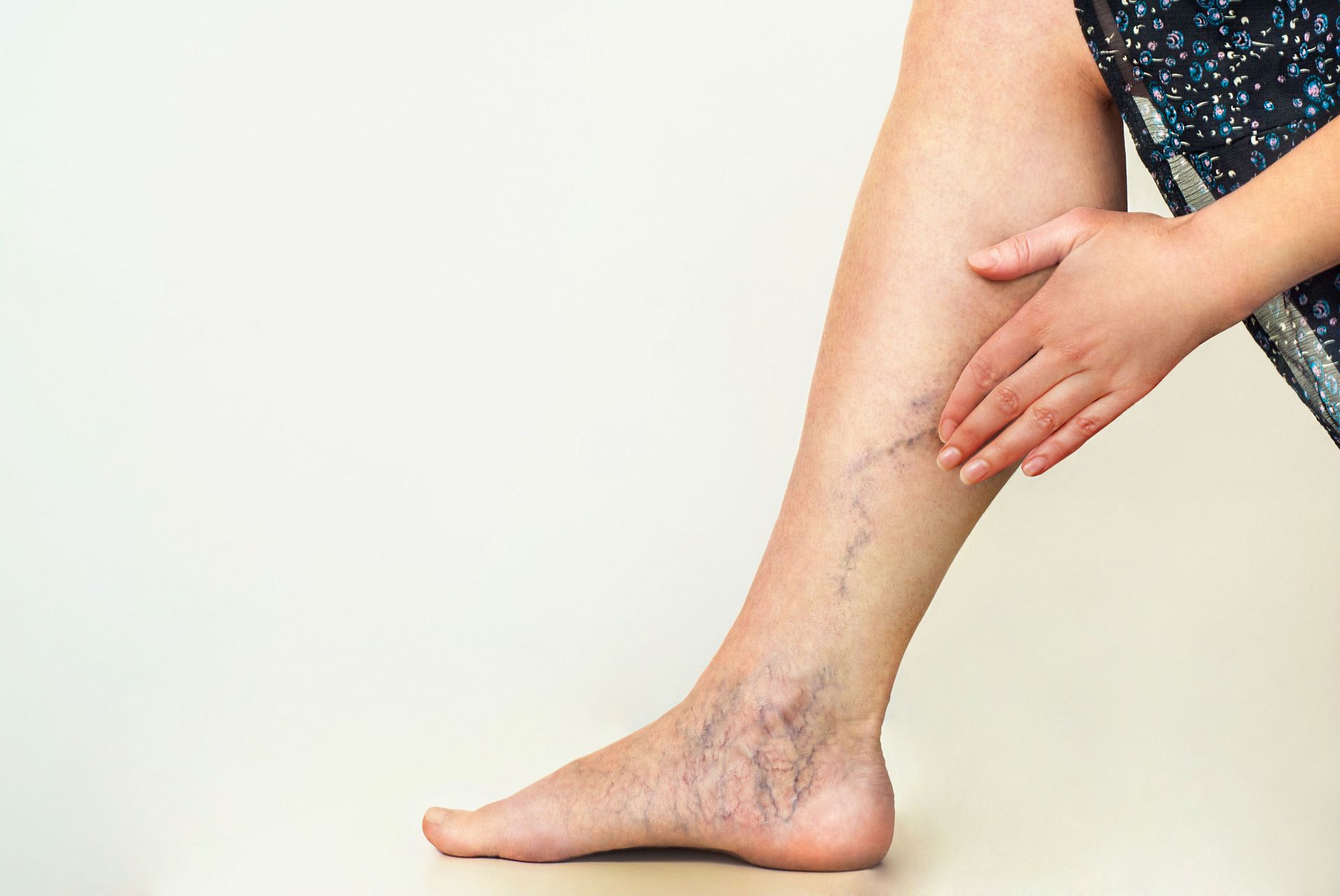3 Reason to Treat Varicose Veins