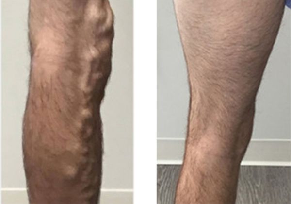 A before and after picture of a man's leg with varicose veins.