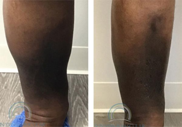 A before and after photo of a person's leg.