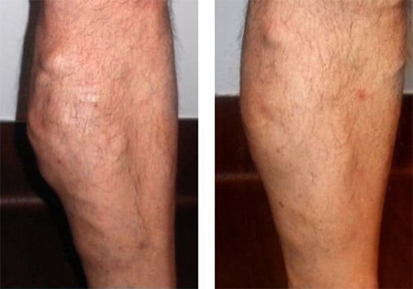 A before and after photo of a person's legs with varicose veins